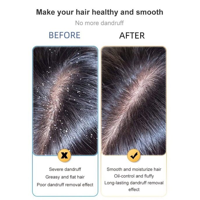 Happy%20day%20anti%20dandruff%20shampoo%20300ml%20dandruff%20treatment%20oil%20control%20sea%20salt%20Shampoo%20syampoo%20kelemumur%20syampu%20Relieve%20itchy%20scalp%20Bald%20Deep%20clean%20scalp%20reduce%20dandruff%20hair%20treatment%20removes%20mites%20Scalp%20Care%20scalp%20psoriasis%20%E4%BA%8C%E7%A1%AB%E5%8C%96%E7%A1%92%E5%8E%BB%E5%B1%91%E6%B4%97%E5%8F%91%E6%B0%B4%20-%20Image%202