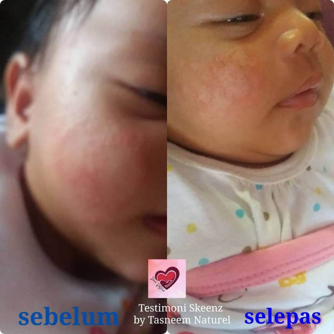 Skeenz Balm Tasneem Naturel Untuk Baby Ekzema, Ruam, Masalah Kulit 