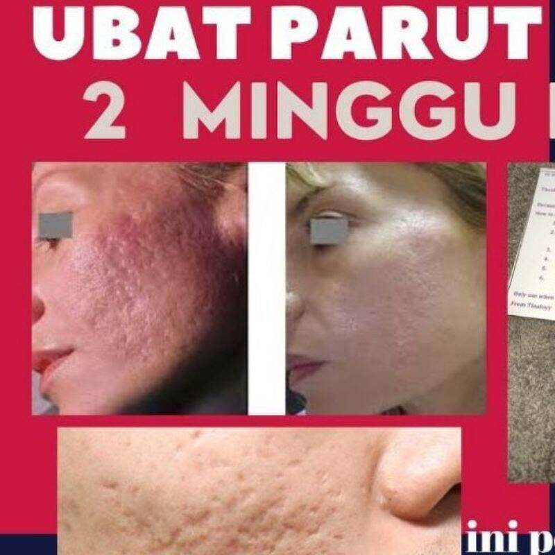 Ubat Jerawat Ubat Jeragat Pemutih Muka Serum Jerawat Ubat Parut Muka Ubat Putihkan Kulit Lazada