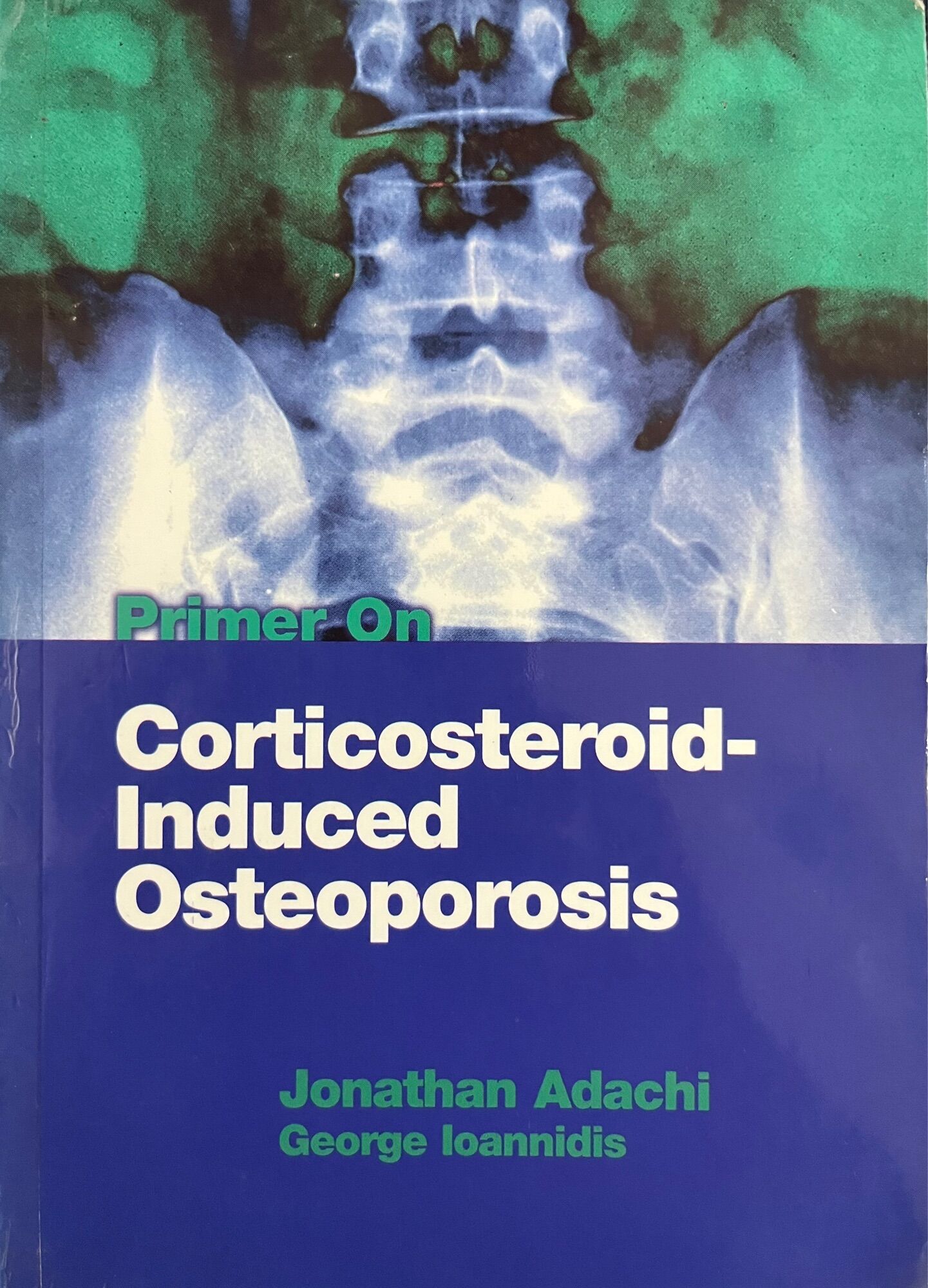 CorticosteroidInduced Osteoporosis Lazada