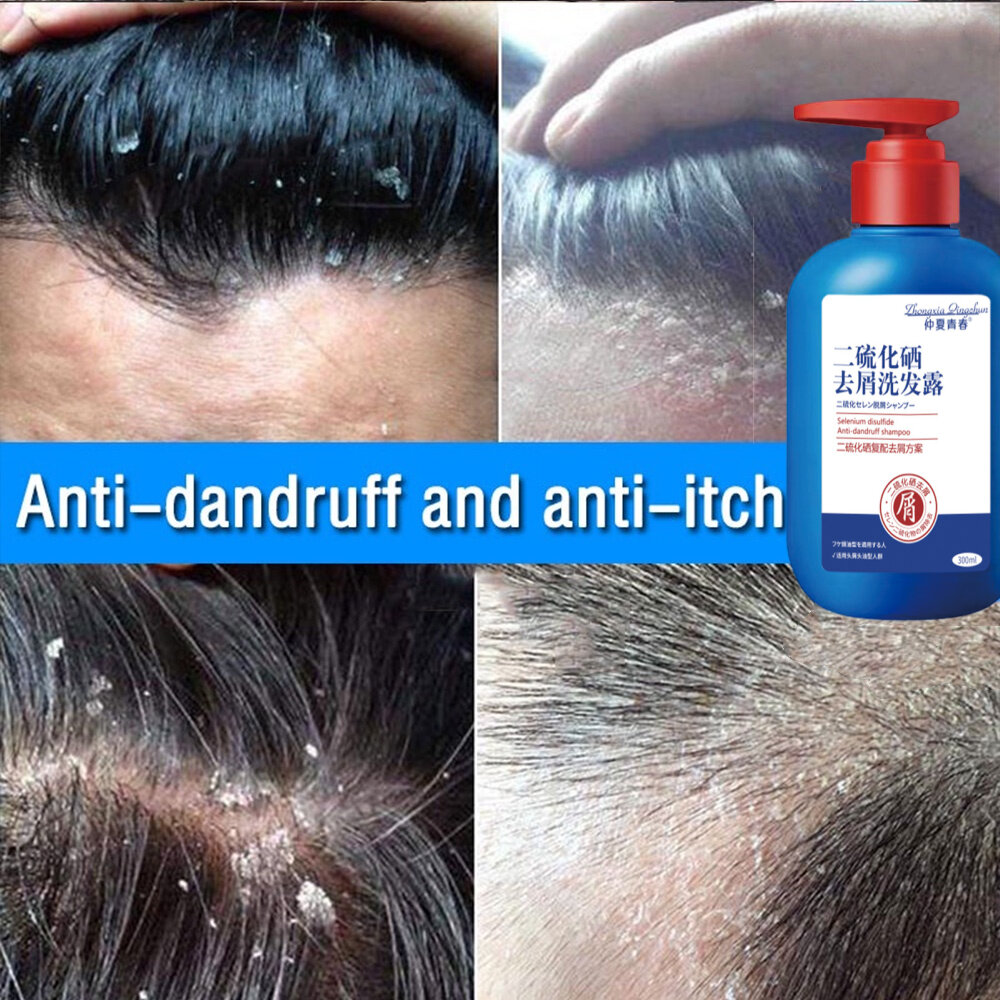 Happy%20day%20anti%20dandruff%20shampoo%20300ml%20dandruff%20treatment%20oil%20control%20sea%20salt%20Shampoo%20syampoo%20kelemumur%20syampu%20Relieve%20itchy%20scalp%20Bald%20Deep%20clean%20scalp%20reduce%20dandruff%20hair%20treatment%20removes%20mites%20Scalp%20Care%20scalp%20psoriasis%20%E4%BA%8C%E7%A1%AB%E5%8C%96%E7%A1%92%E5%8E%BB%E5%B1%91%E6%B4%97%E5%8F%91%E6%B0%B4%20-%20Image%203