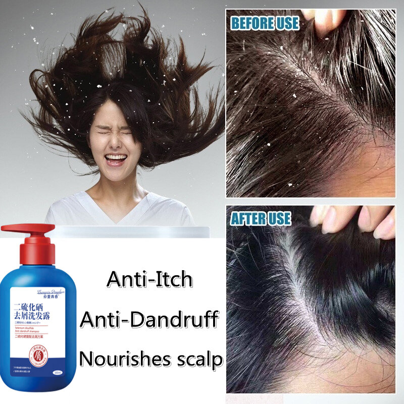 Happy%20day%20anti%20dandruff%20shampoo%20300ml%20dandruff%20treatment%20oil%20control%20sea%20salt%20Shampoo%20syampoo%20kelemumur%20syampu%20Relieve%20itchy%20scalp%20Bald%20Deep%20clean%20scalp%20reduce%20dandruff%20hair%20treatment%20removes%20mites%20Scalp%20Care%20scalp%20psoriasis%20%E4%BA%8C%E7%A1%AB%E5%8C%96%E7%A1%92%E5%8E%BB%E5%B1%91%E6%B4%97%E5%8F%91%E6%B0%B4%20-%20Image%204