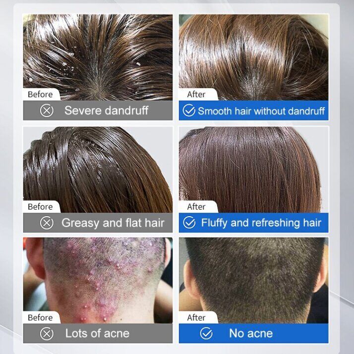Happy%20day%20anti%20dandruff%20shampoo%20300ml%20dandruff%20treatment%20oil%20control%20sea%20salt%20Shampoo%20syampoo%20kelemumur%20syampu%20Relieve%20itchy%20scalp%20Bald%20Deep%20clean%20scalp%20reduce%20dandruff%20hair%20treatment%20removes%20mites%20Scalp%20Care%20scalp%20psoriasis%20%E4%BA%8C%E7%A1%AB%E5%8C%96%E7%A1%92%E5%8E%BB%E5%B1%91%E6%B4%97%E5%8F%91%E6%B0%B4%20-%20Image%206