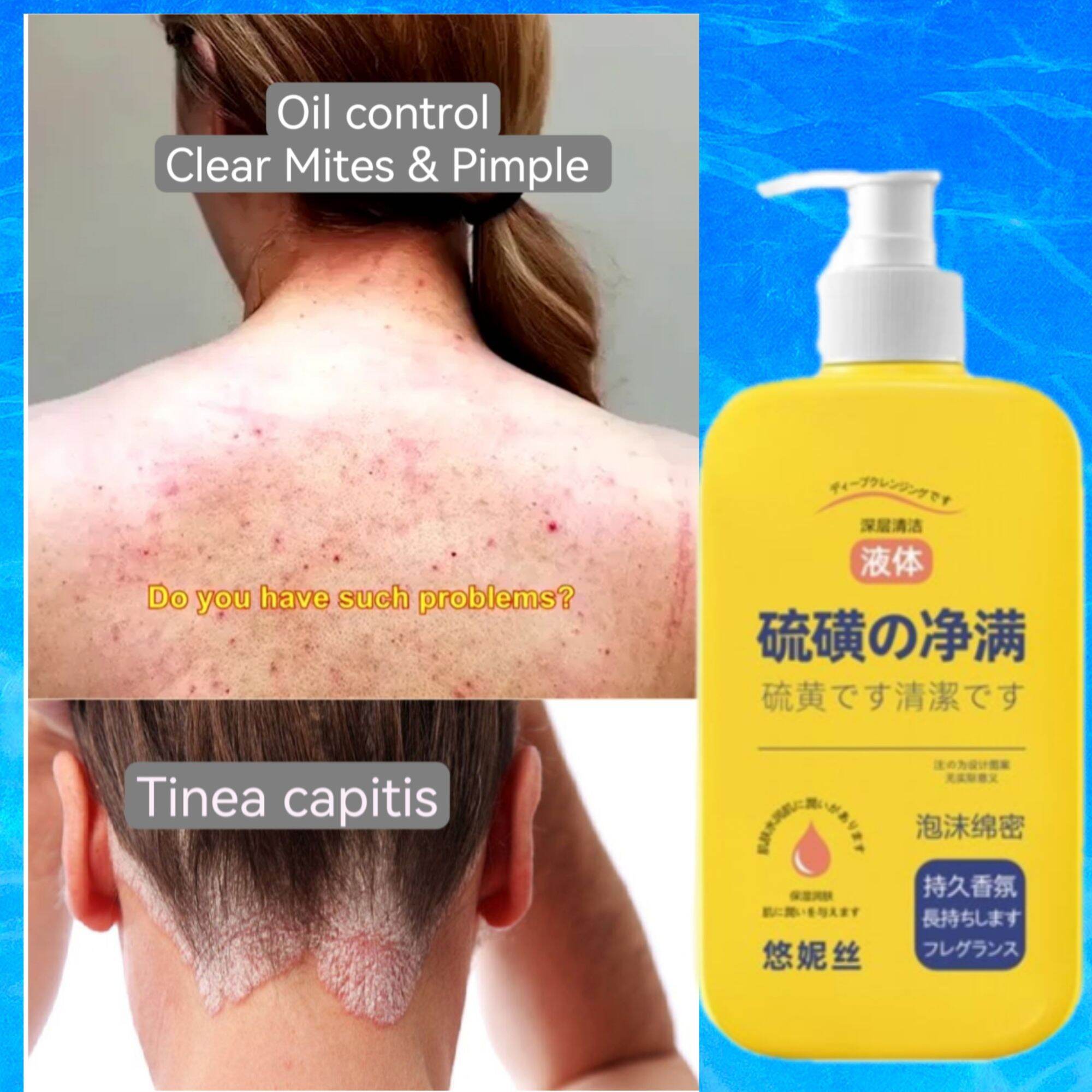 300ml Antibacterial Sulfur Cleansing Ekzema Tinea corporis Scalp Mite